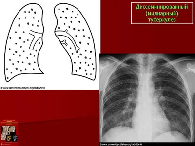 Милиарный туберкулез - причины появления, симптомы заболевания, диагностика  и способы лечения