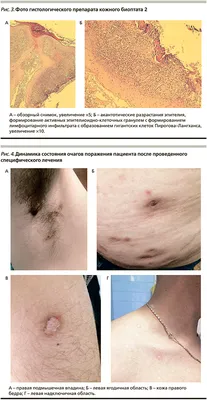 ФАРМАТЕКА » Распространенная скрофулодерма и диссеминированный туберкулез  легких на фоне ВИЧ-инфекции