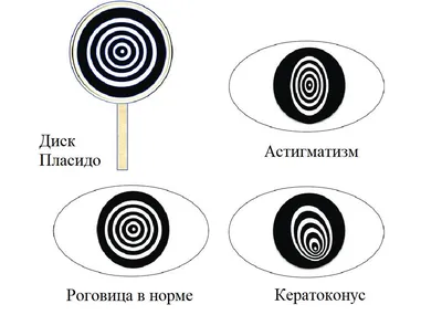Что такое синдром «красного глаза»? «Ochkov.net»