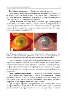 Стволовые клетки лимба помогли людям с ожогами роговицы в первой фазе  испытаний. У троих из четырех пациентов улучшилось зрение