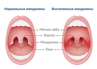 Разрастание ткани в горле