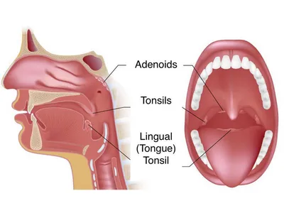 Тонзиллит: симптомы, причины, диагностика и лечение | Блог ЛДЦ Здоровье