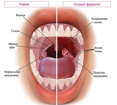 Тонзиллит у детей - причины, симптомы, лечение в клинике «Будь Здоров»