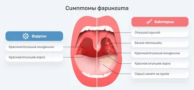 Лимфоидная ткань в горле фото фото