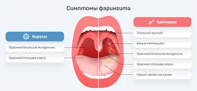 Хронический тонзиллит (ангина) | Реальный медик | Дзен