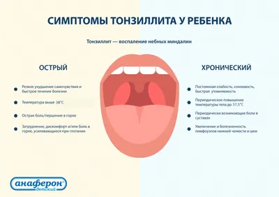 Лекарственные препараты для лечения фарингита: список лучших и их виды