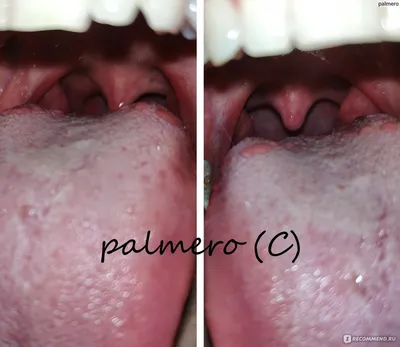 PDF) Complex topical treatment of patients with infectious and inflammatory  pharyngeal pathology