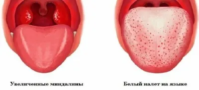 Фарингит у взрослых: лечение фарингита у взрослого, симптомы острого и  хронического фарингита