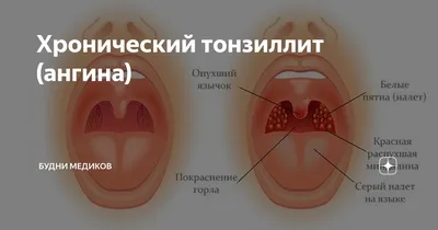 Как выявить и вылечить фарингит, и чем он опасен