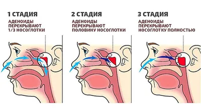 Хронический фарингит у детей