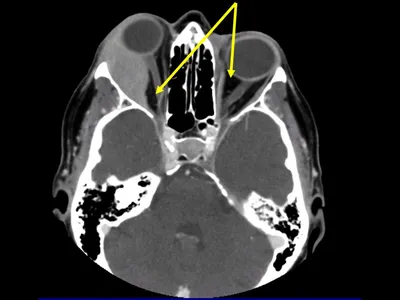 Опухоли орбиты у взрослых: клинический, радиологический и...