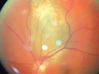 Лимфомы орбиты глаза: причины, симптомы, диагностика и лечение