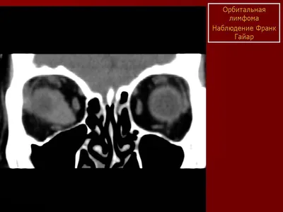 Офтальмологические проявления вирусной лейкемии кошек /Ocular  manifestations of feline leukemia virus infection