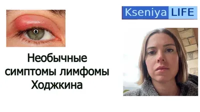 Рак лимфатической системы: что необходимо знать пациентам и их близким? |  Клиника Хадасса