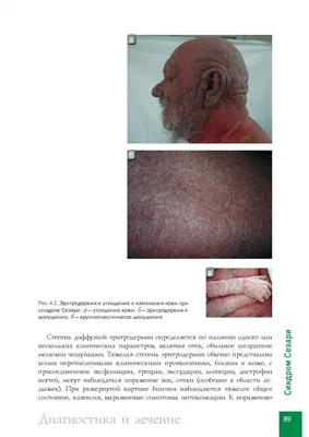 Лимфома Ходжкина (нодулярный склероз) - причины, симптомы, лечение в Москве