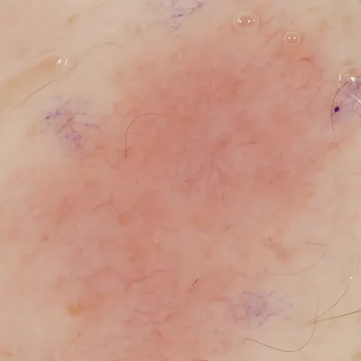 Первичная В-клеточная лимфома кожи | DERMATOLOGY-ONLINE | Дзен