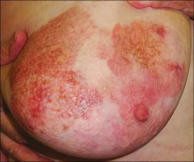 Skin lymphomas (photogallery) - Olisova - Russian Journal of Skin and  Venereal Diseases