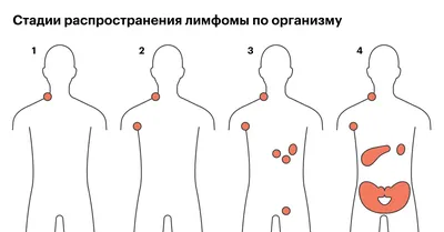 Неходжкинская лимфома: симптомы, признаки, лечение, прогноз