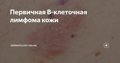 Иллюстрация 10 из 14 для Лимфомы кожи. Диагностика и лечение - Потекаев,  Виноградова, Виноградов | Лабиринт - книги.