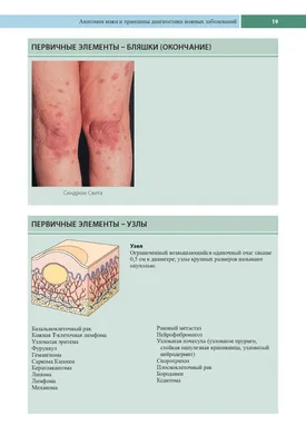 Первичная В-клеточная лимфома кожи | DERMATOLOGY-ONLINE | Дзен