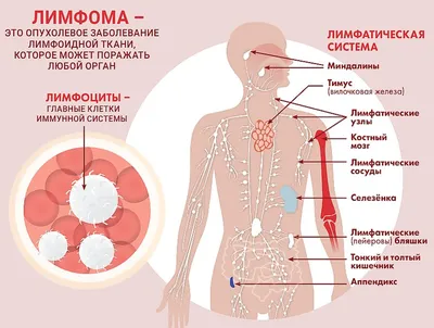 Медицинский центр «Хадасса» Hadassah Medical Center - Рецидив лимфомы: что  делать, если болезнь вернулась? Лимфома – опасное системное заболевание,  борьба с которым отнимает много жизненных ресурсов. Поэтому вполне  естественно, что после успешного