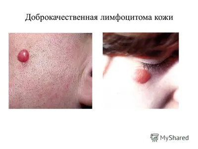 Cutaneous and visceral leishmaniasis in patients with HIV infection in  Russia. Case report - Ermak - Terapevticheskii arkhiv