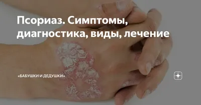 Что такое болезнь Лайма, которой болеют Белла Хадид и другие знаменитости