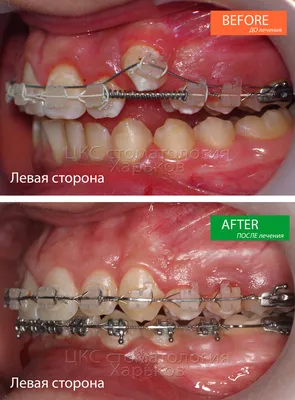 Лингвальные брекеты - Сити Дент