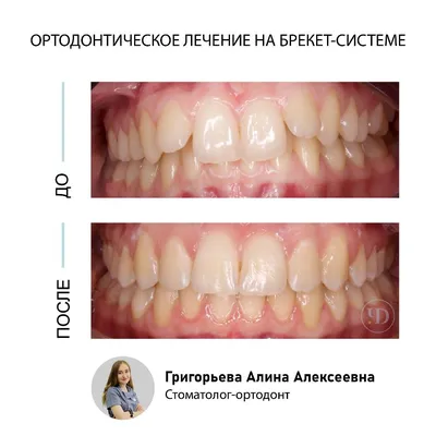 Фотографии до и после лечения зубов в Стоматологии ТариДент