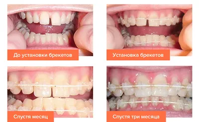 Лингвальные брекеты в Калининграде: виды, цены, акции, примеры