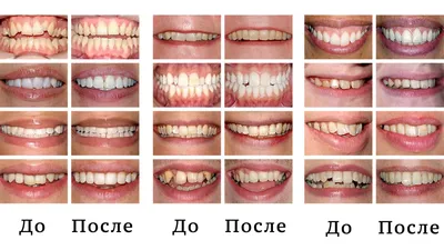 Лицо до и после брекетов - как меняется лицо после исправления прикуса