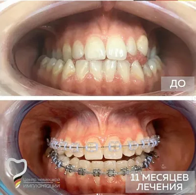 Установка брекетов до и после фото - Центр Семейной Стоматологии в Кожухово