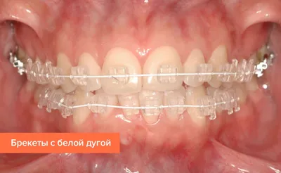 Брекеты Incognito - лингвальные невидимые брекет-системы Инкогнито. Цена  установки и стоимость лечения в Москве | Ортодонт-центр Ортодонтика