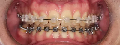 Установка металлической брекет-системы недорого, цена 40500 руб. в Москве