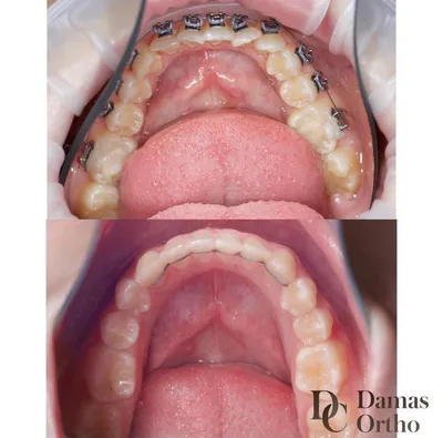 Керамические брекеты ➡️ Цена керамической брекет системы в Киеве ✓ Клиника  Доброго Стоматолога