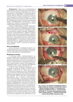 Хирургическое лечение эпибульбарных опухолей органа зрения с применением  биоматериалов Аллоплант