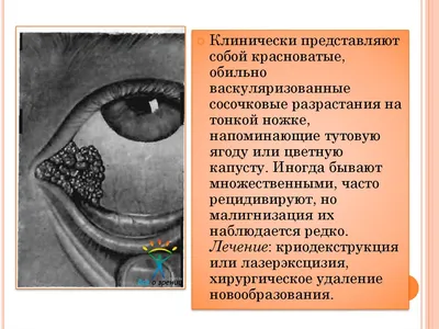 Лечение заболеваний и патологий слезных путей (закупорка, непроходимость  канала) в в «Микрохирургии глаза» Екатеринбург