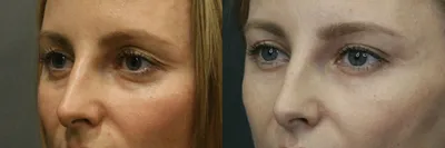 Липофилинг лица до и после, реабилитация и противопоказания — Украинская  академия пластической хирургии