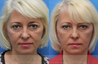 ᐉ Фото до и после — липофилинг лица, фотографии до и после операции  липофилинг лица, фото результатов операции