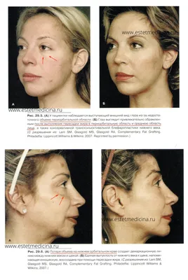 ᐉ Фото до и после — липофилинг лица, фотографии до и после операции  липофилинг лица, фото результатов операции