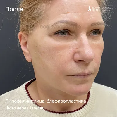 Липофилинг лица: цена, реабилитация, отзывы | Интернет-журнал  Estetmedicina.ru