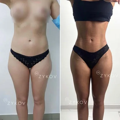 Фото до и после пластических операций на теле