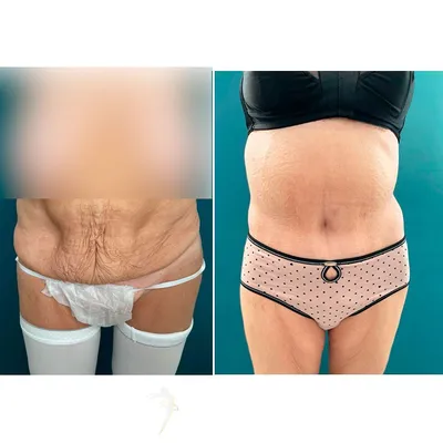 Фото до и после пластических операций на теле