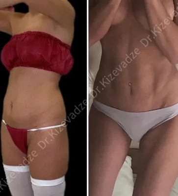 Операция бодилифт: фото до и после