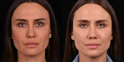 Липофилинга лица фото до и после | Клиника Доктора Гришкяна |