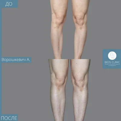 Липофилинг голеней и бедер: цены в Санкт-Петербурге, фото результатов,  отзывы