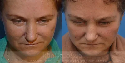 Липофилинг контуров тела до и после, противопоказания и реабилитация —  Украинская академия пластической хирургии