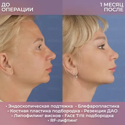 Фото до и после - Липофилинг лица