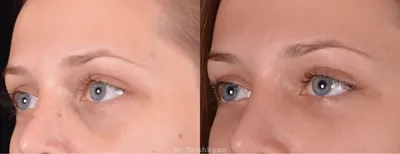 Липофилинг слезной борозды фото до и после фото