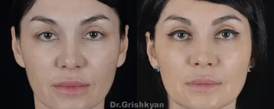 Липофилинга лица фото до и после | Клиника Доктора Гришкяна | - Страница 4  из 6